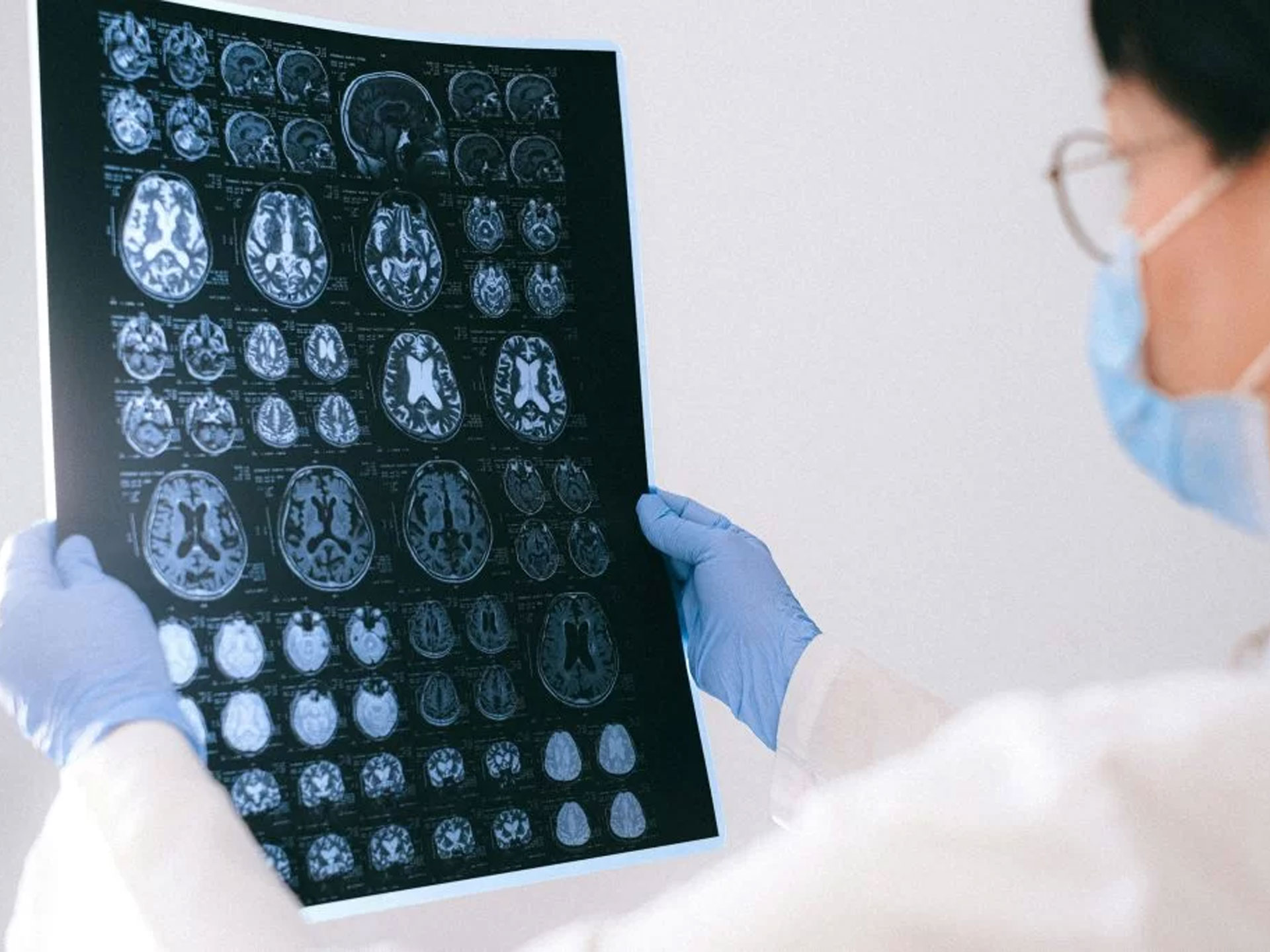 Disturbo cognitivo lieve, individuati possibili fattori di 