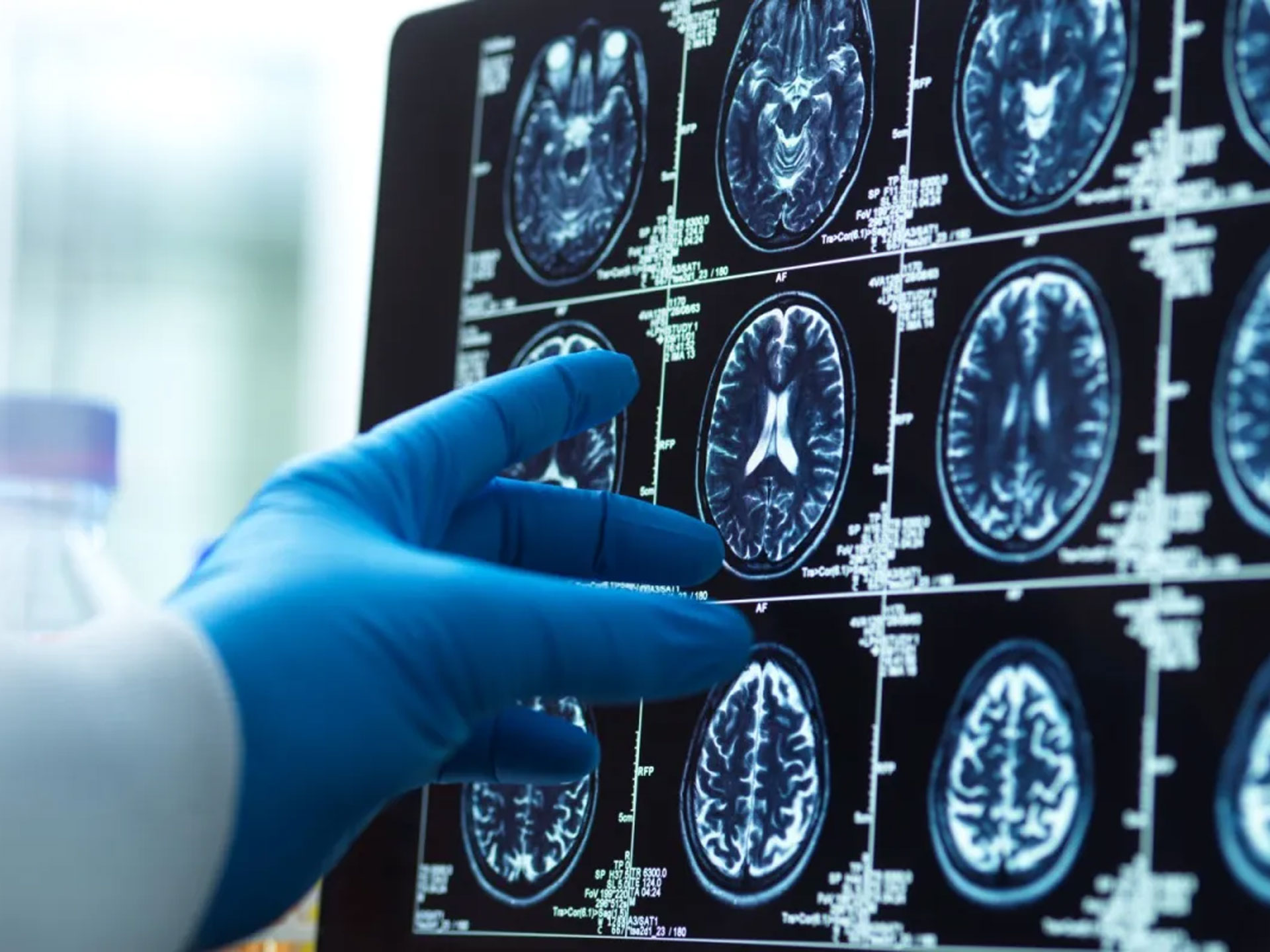 Tumori e Alzheimer: cosa sappiamo dell’associazione inversa