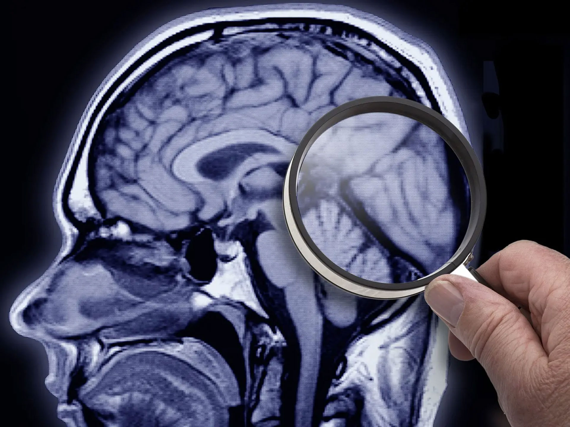 Alzheimer, scoperto legame con un virus intestinale
