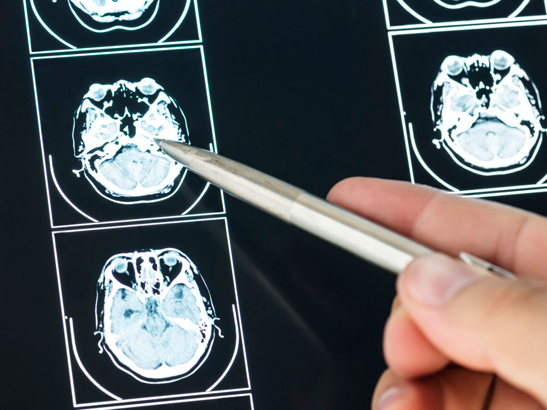 Quando arriveranno i nuovi farmaci contro l’Alzheimer, l’esperto: 