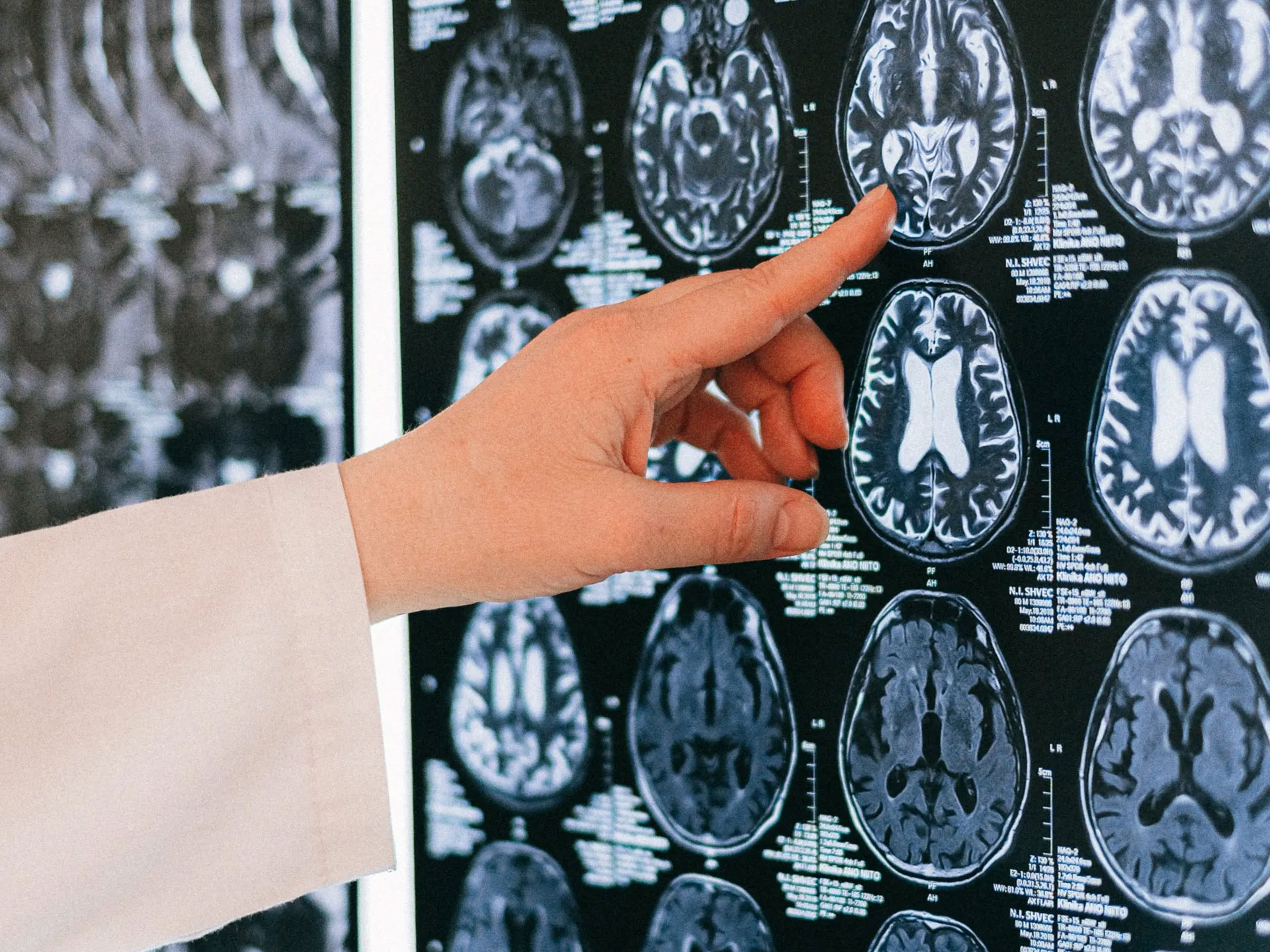 I traumi cranici posso attivare i virus latenti