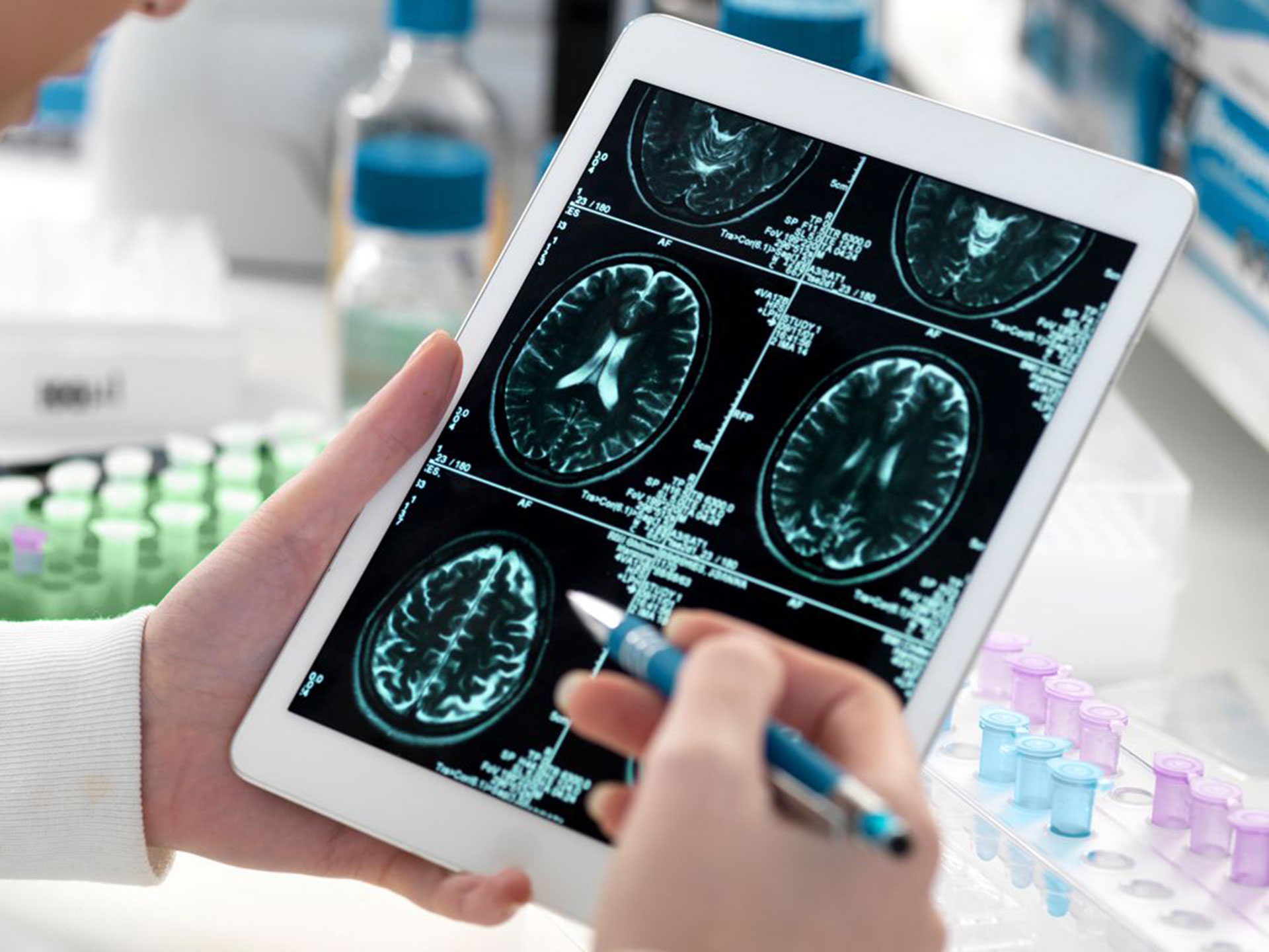 Alzheimer, malattia innescata dalla scorretta ossigenazione del cervello