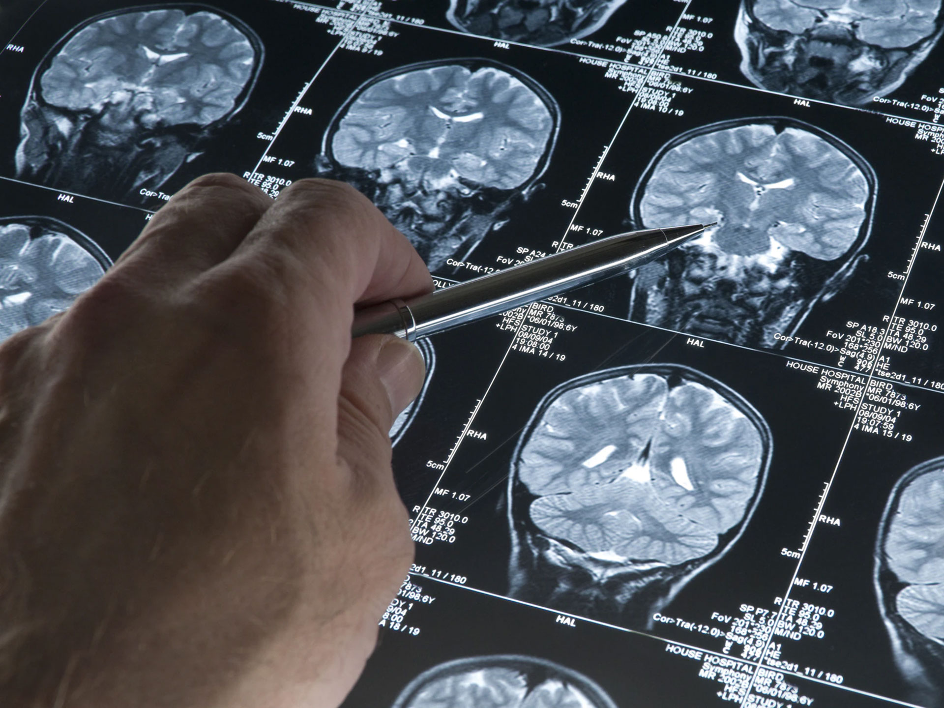 Scoperta la possibile causa dell’Alzheimer: può cambiare tutto per prevenzione e cura