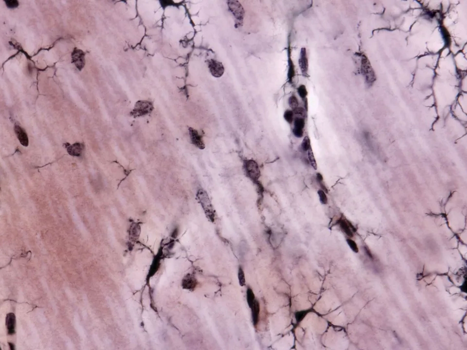 Ecco perché l'Alzheimer colpisce di più le donne: le cellule immunitarie del sistema nervoso centrale sono diverse