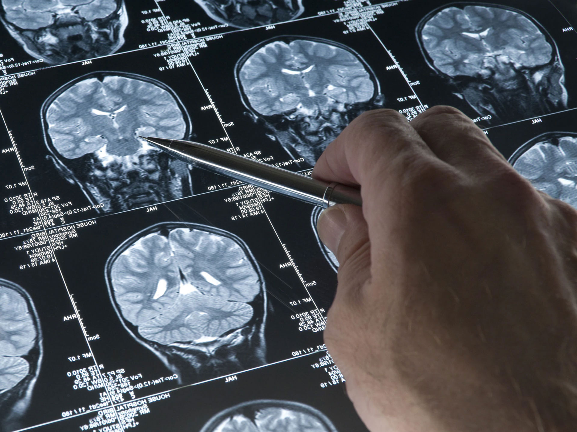 Dalle cure per neonati all’Alzheimer, è italiana la più grande rete europea di ricerca sul cervello