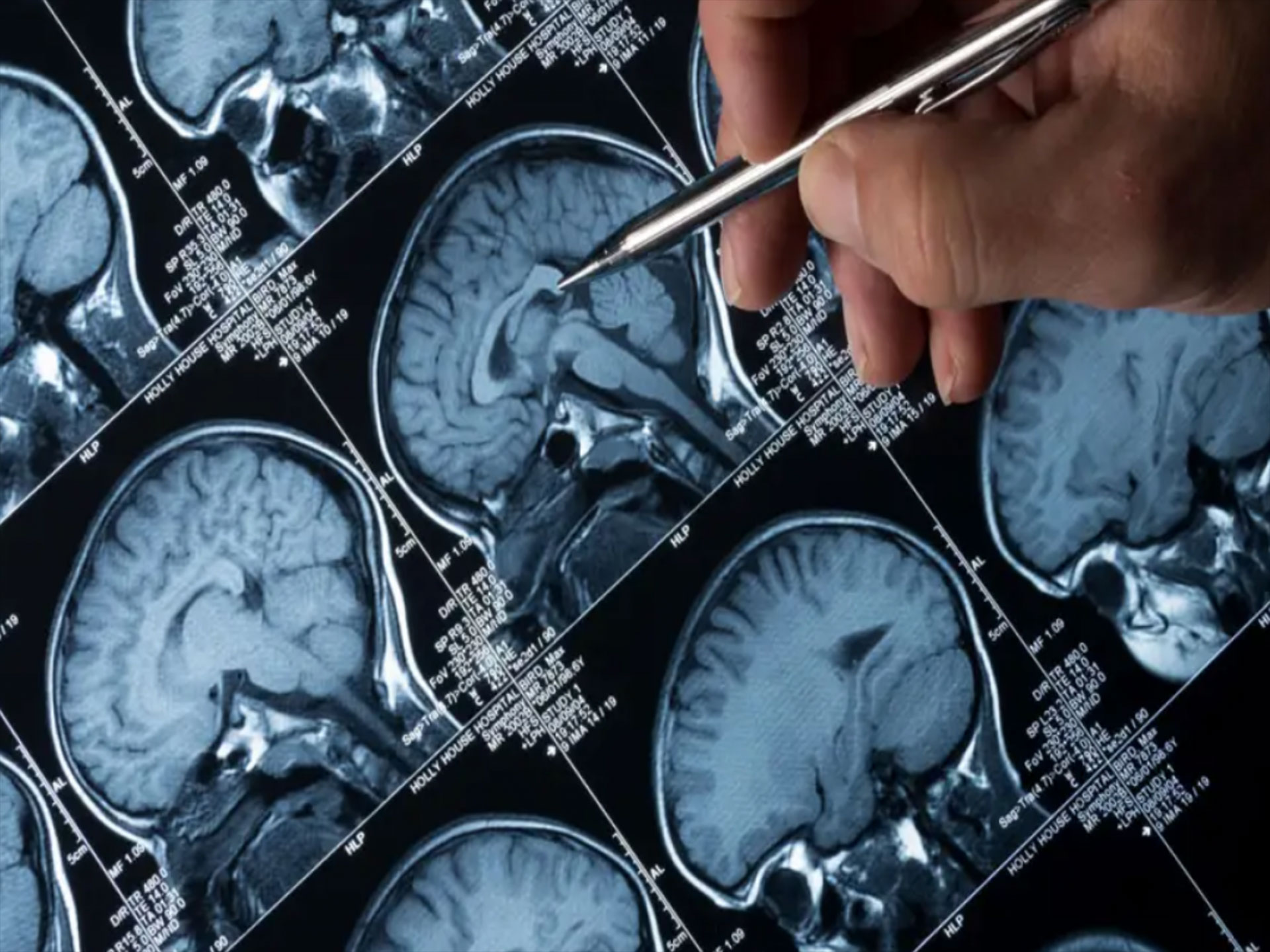 Alzheimer, la nuova terapia: la stimolazione magnetica dimezza (del 52%) la progressione della malattia