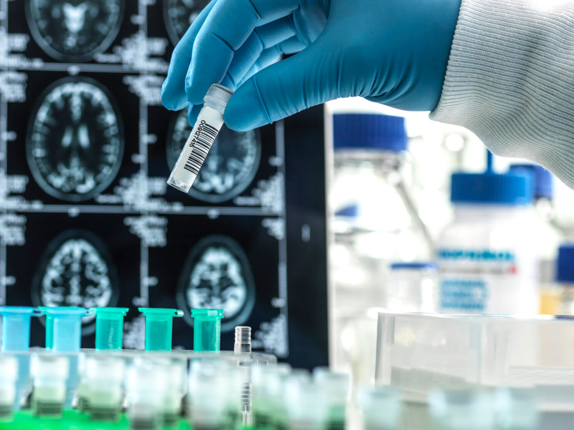 Il nuovo test per l’Alzheimer: diagnosi semplificata o rischio illusorio?